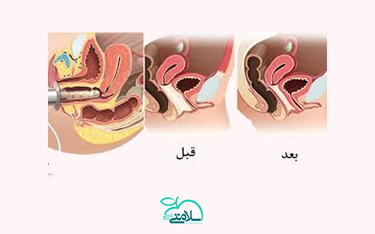 تمام آنچه که باید درباره لیزر واژن بدانید